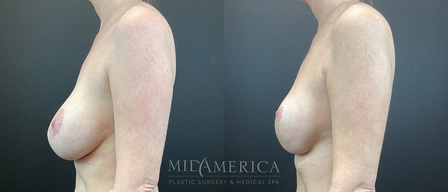 Implant Exchange Before & After