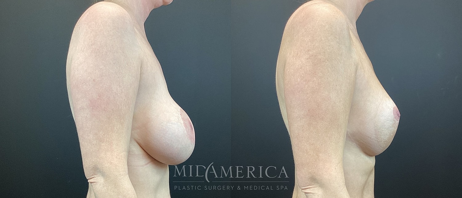 Implant Exchange Before & After