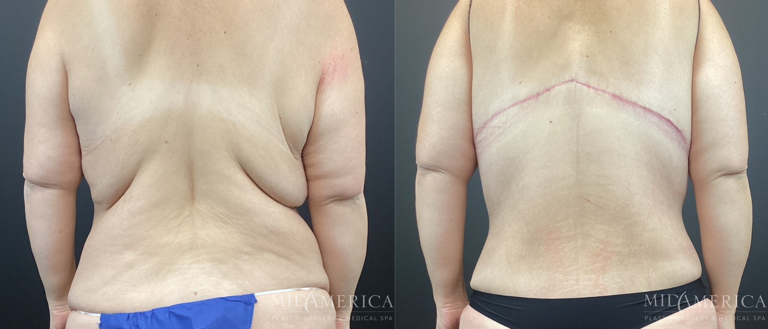 Bra Roll Excision Before & After