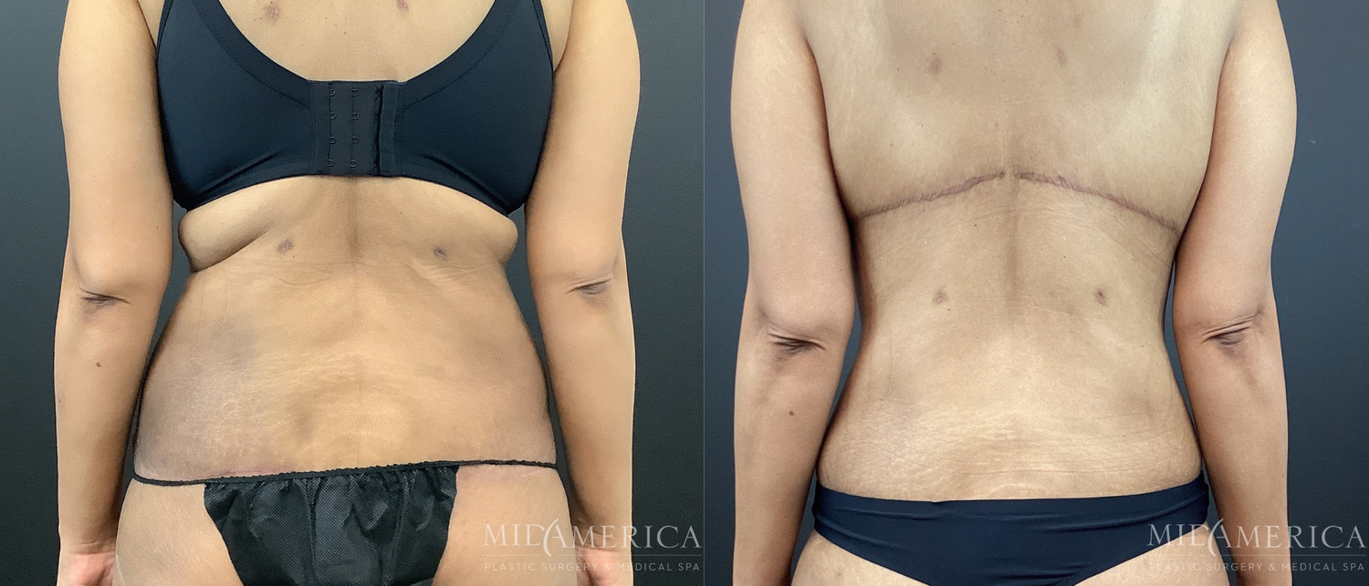 Bra Roll Excision Before & After