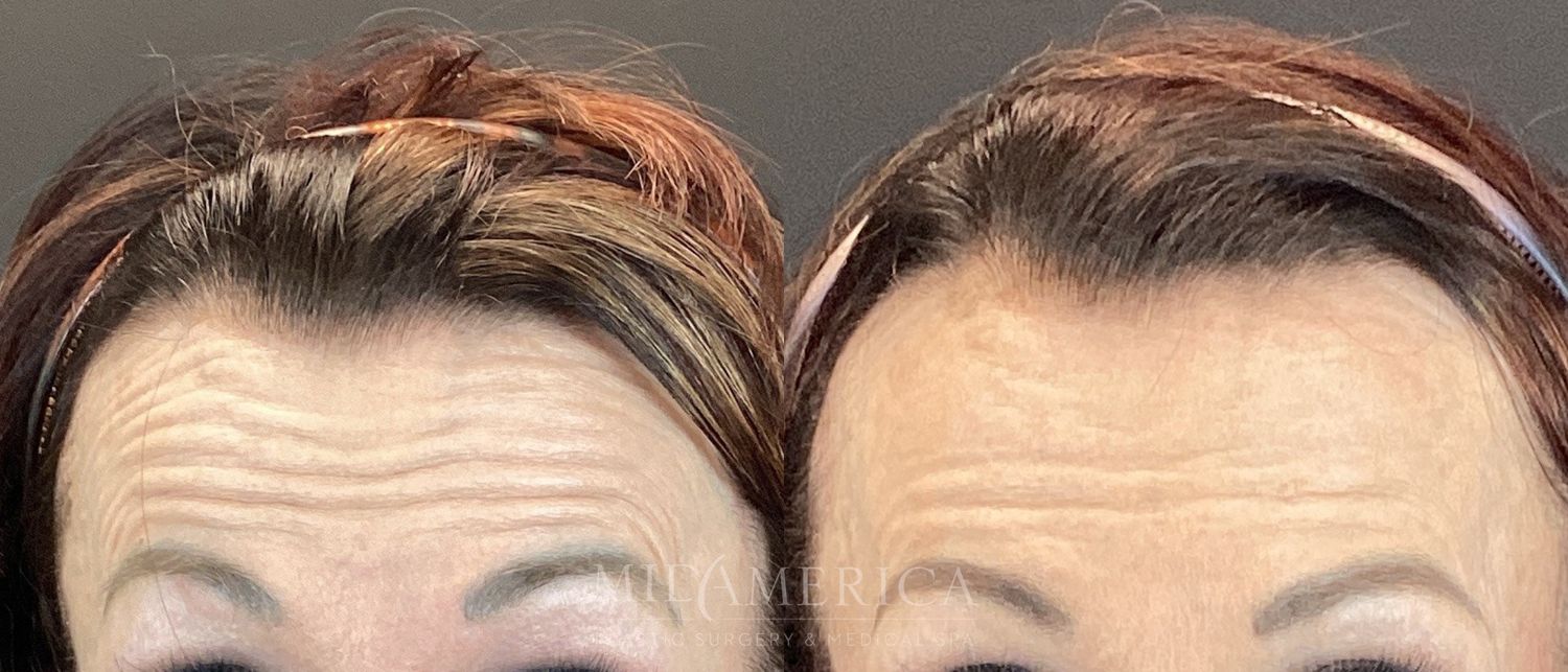 Botox Dysport Before & After