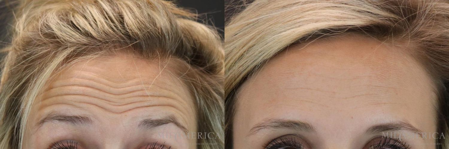 Botoxdysport Before & After