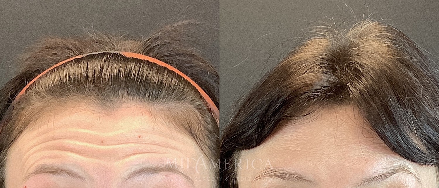 Botox Dysport Before & After