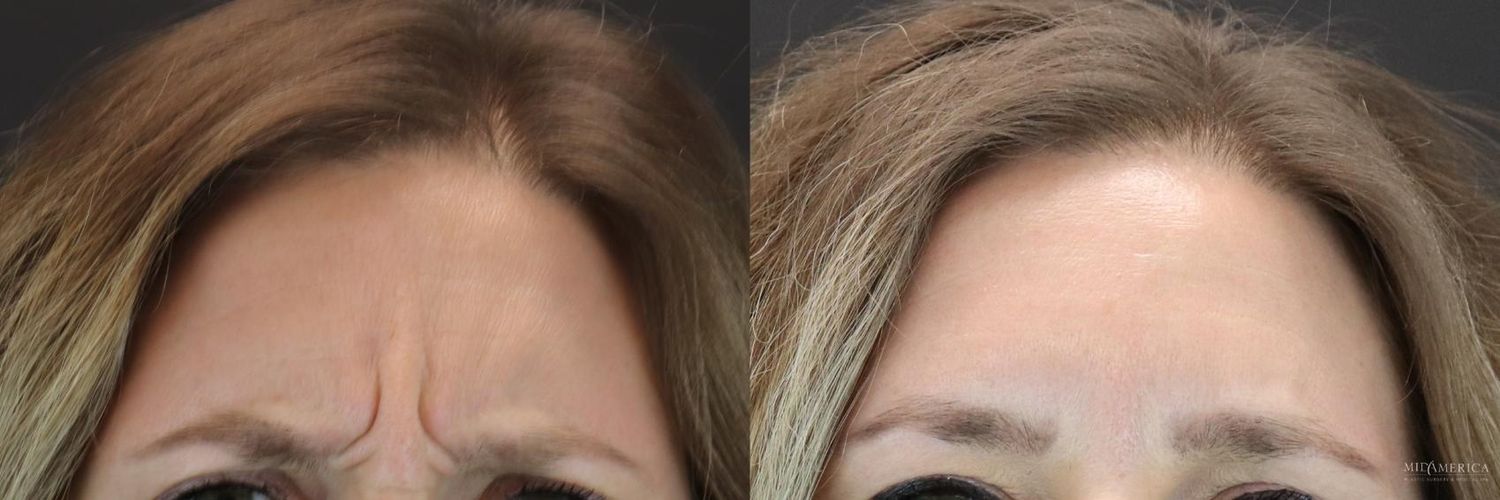 Botoxdysport Before & After
