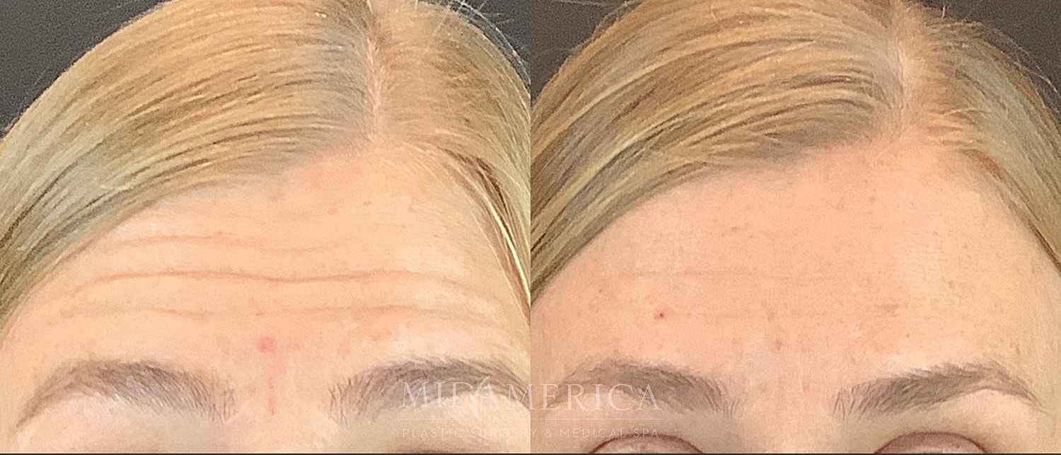 Botox Dysport Before & After