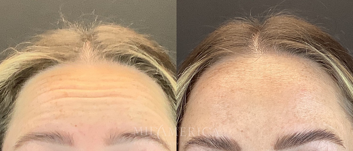 Botox Dysport Before & After