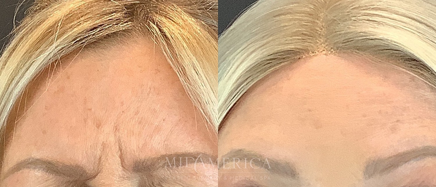 Botox Dysport Before & After