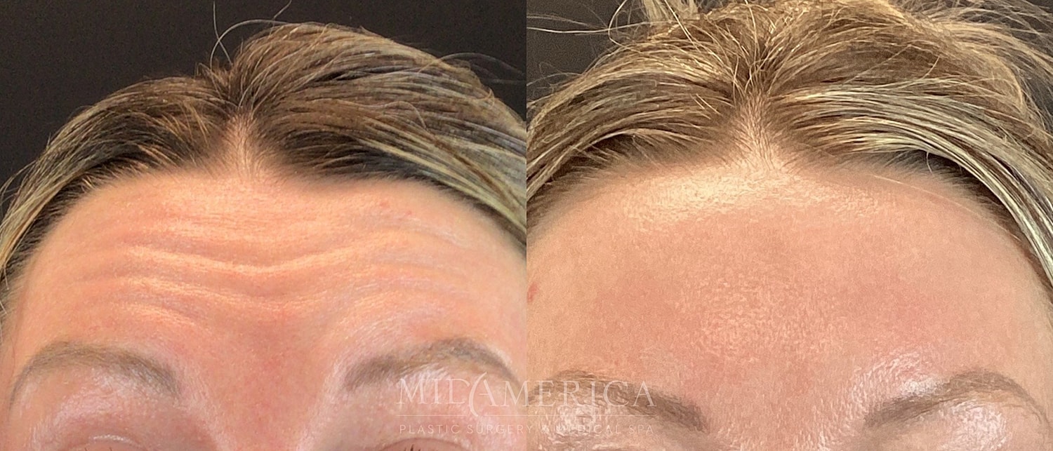 Botox Dysport Before & After