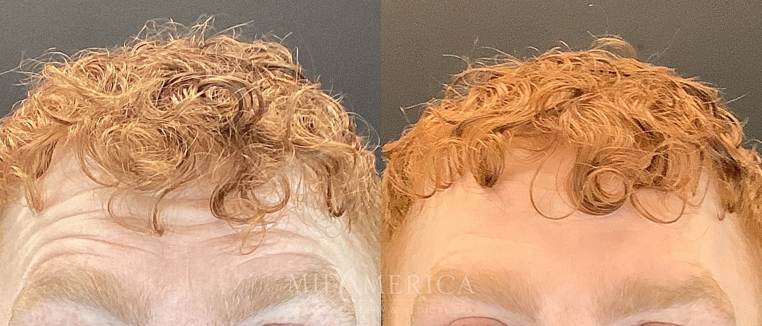 Botox Dysport Before & After