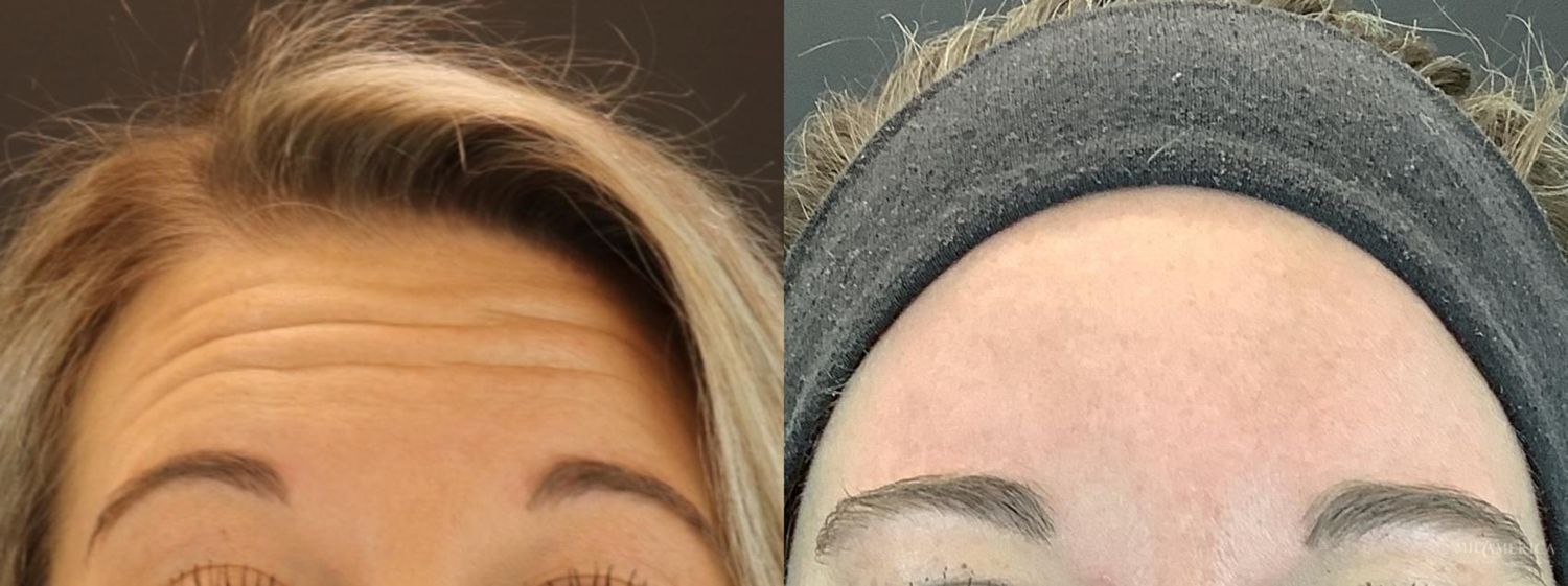 Botoxdysport Before & After