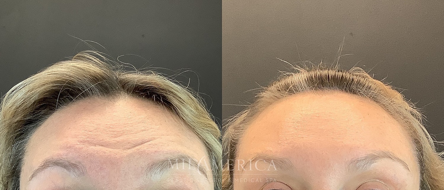 Botox Dysport Before & After