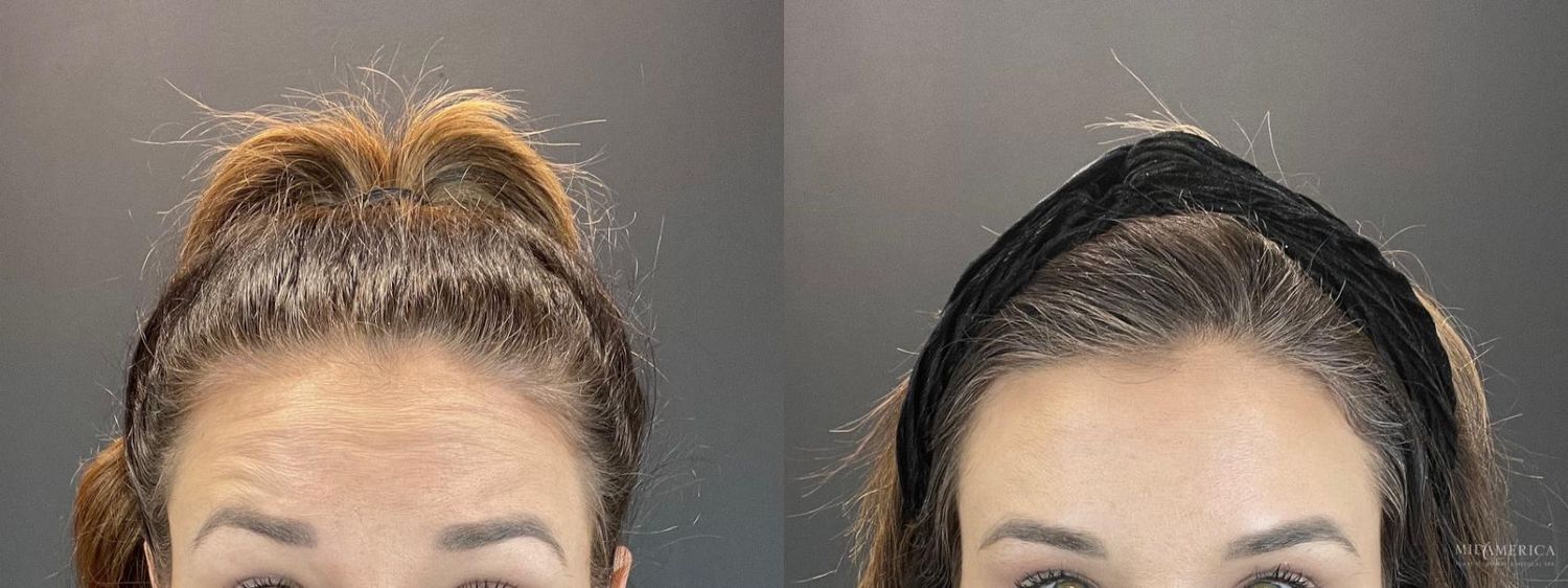 Botoxdysport Before & After