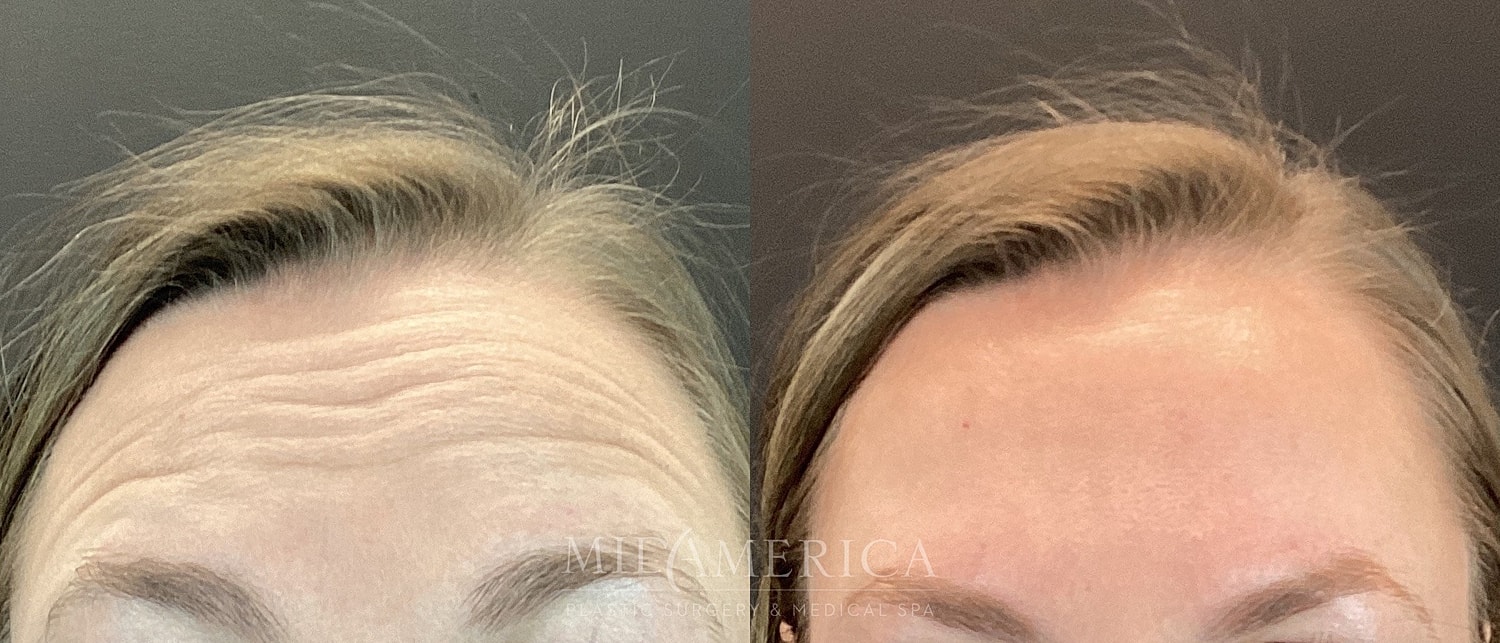 Before and after forehead treatment comparison image