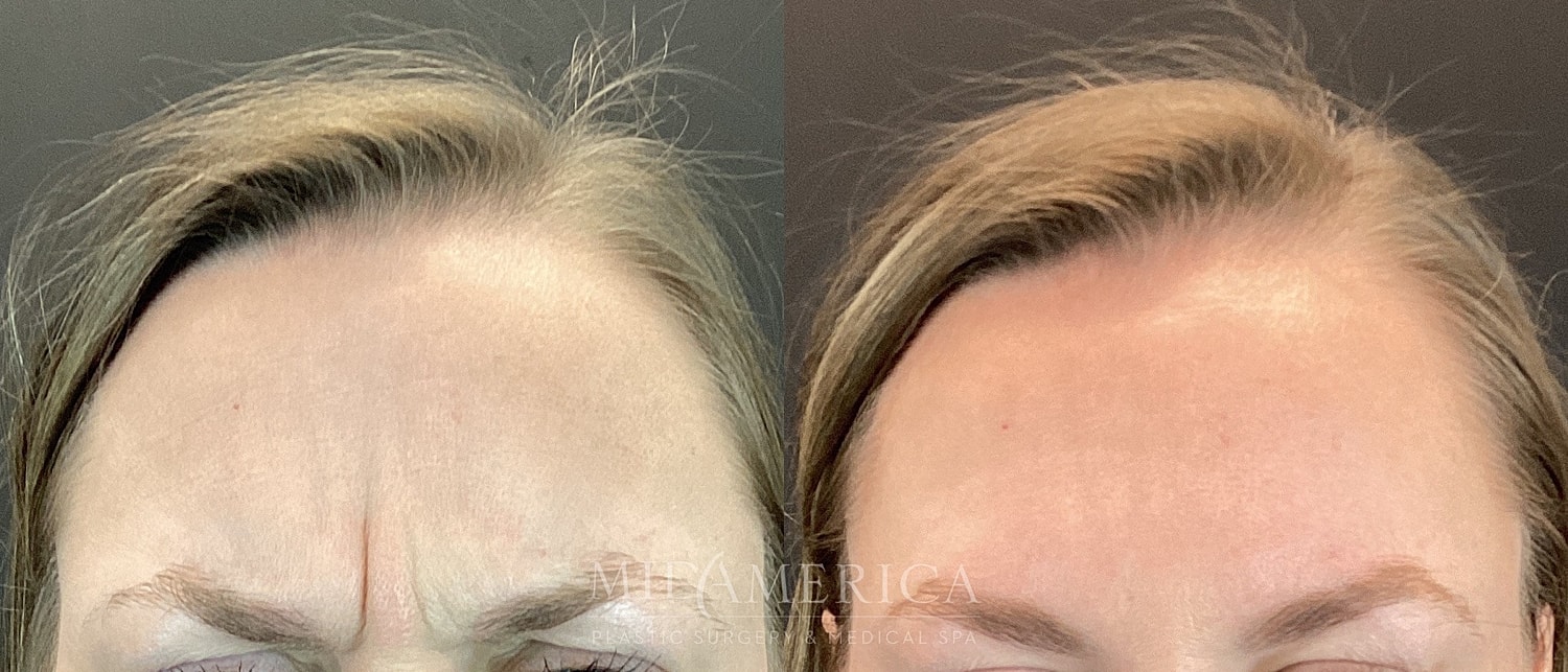 Before and after forehead appearance comparison