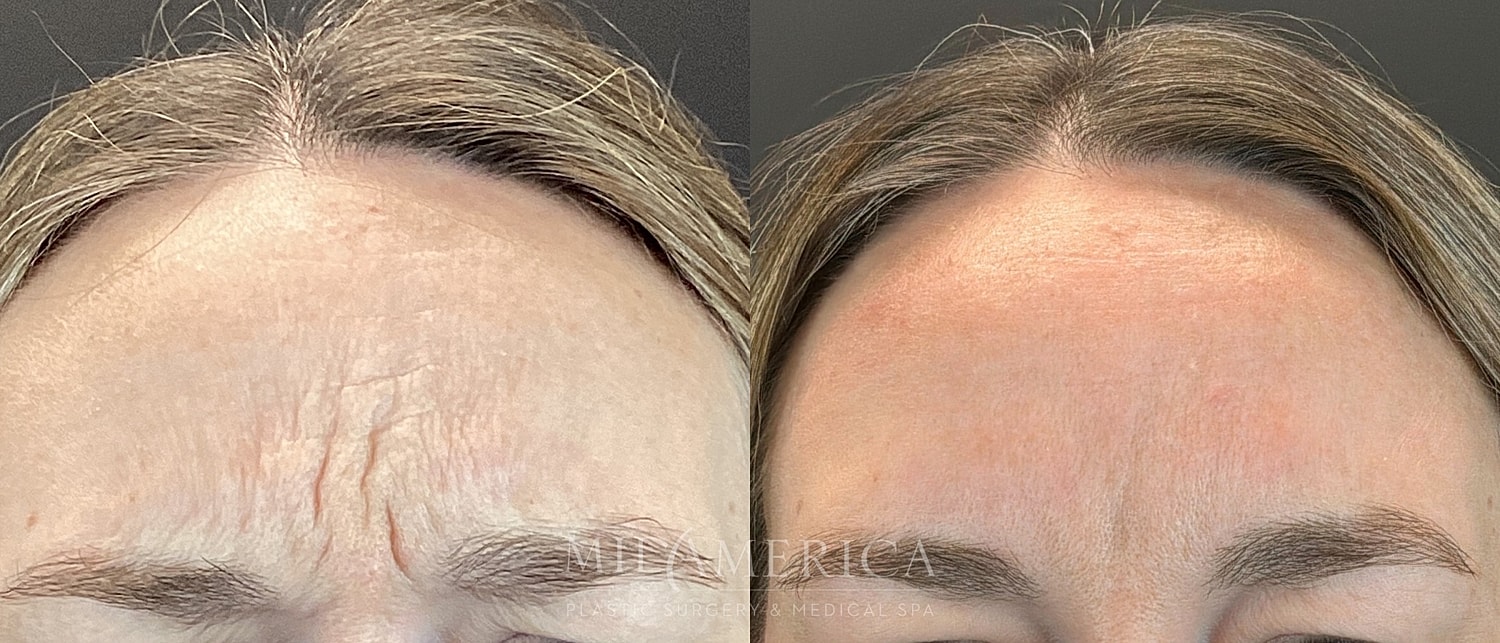 Botox Dysport Before & After