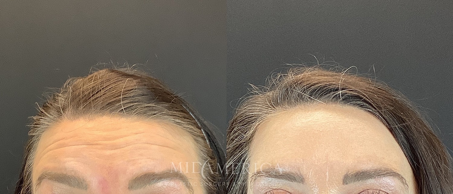 Botox Dysport Before & After