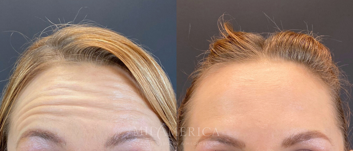 Botox Dysport Before & After