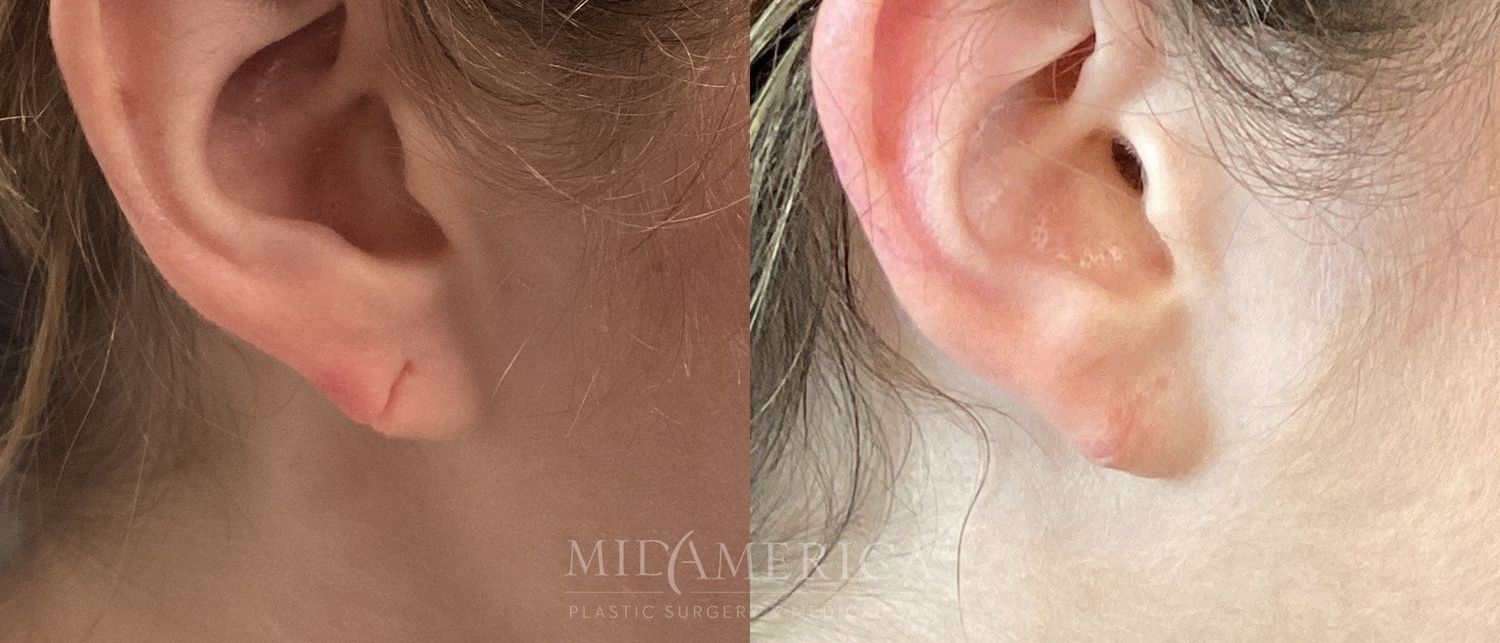 Earlobe Repair Before & After