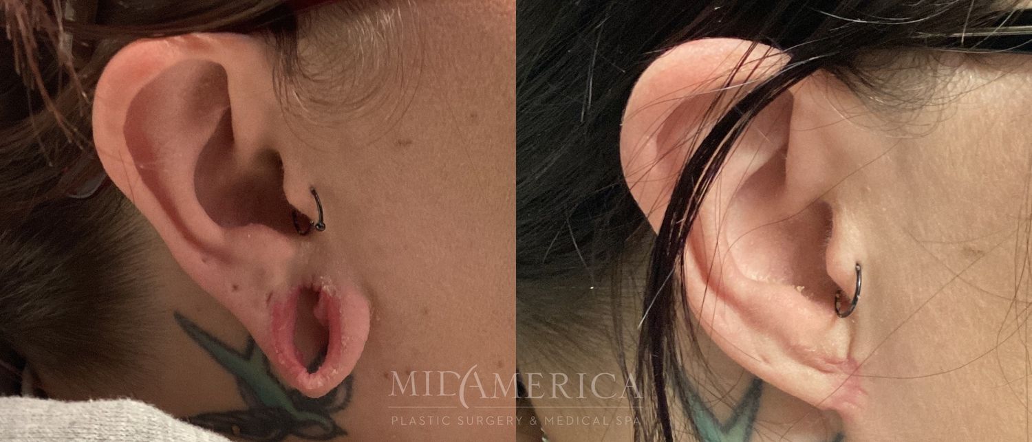 Earlobe Repair Before & After