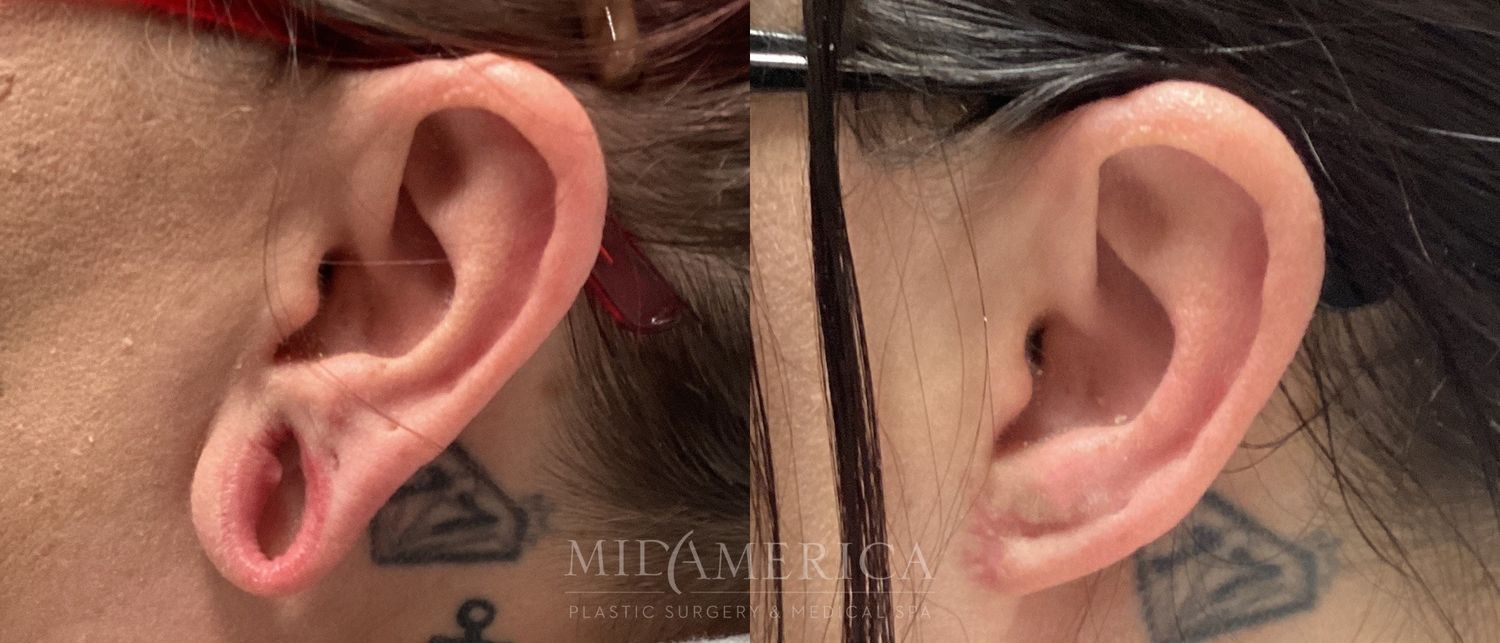 Earlobe Repair Before & After