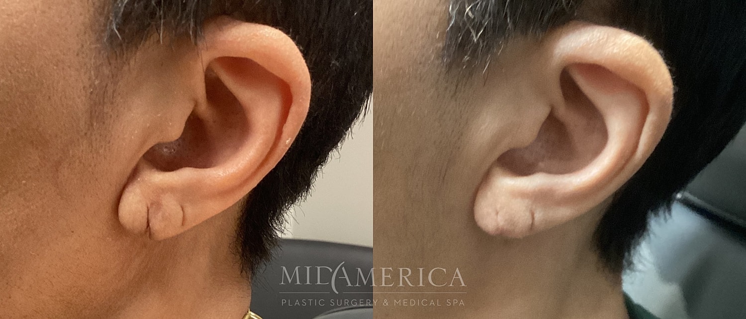 Before and after ear surgery comparison.