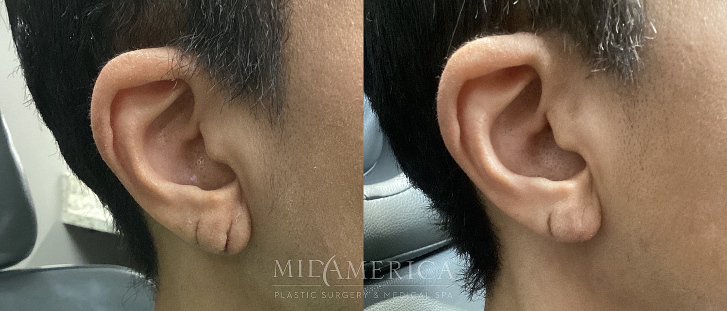 Before and after ear reconstruction images.