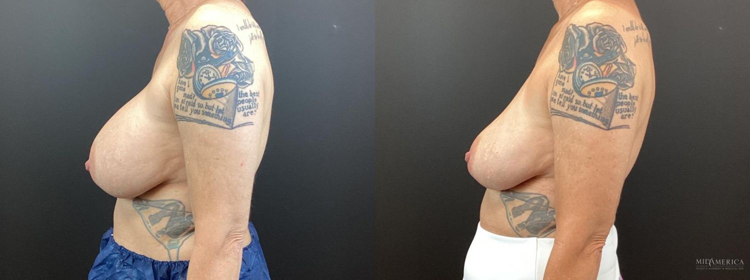 Implant Removal Before & After