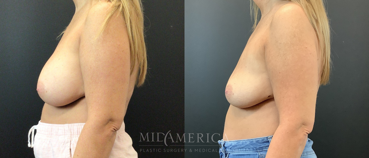 Implant Removal Before & After