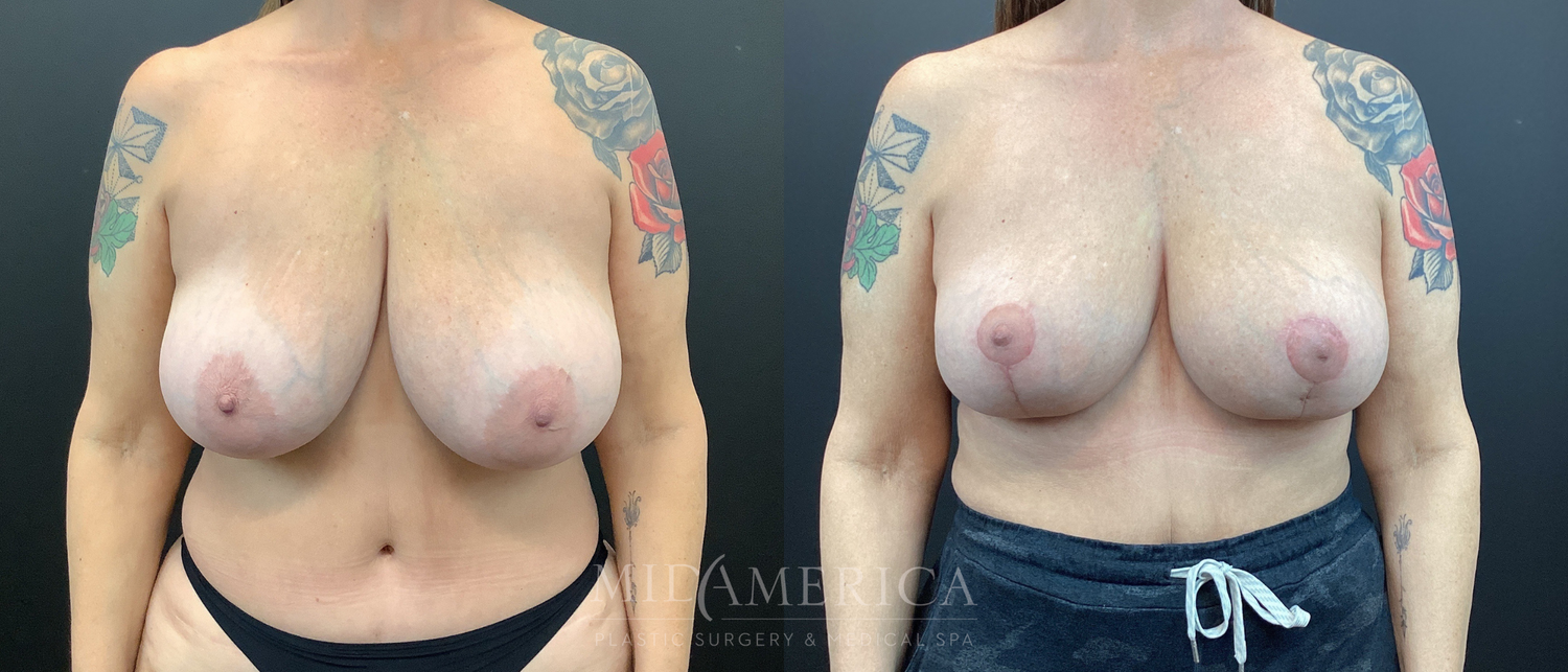 Implant Removal Before & After