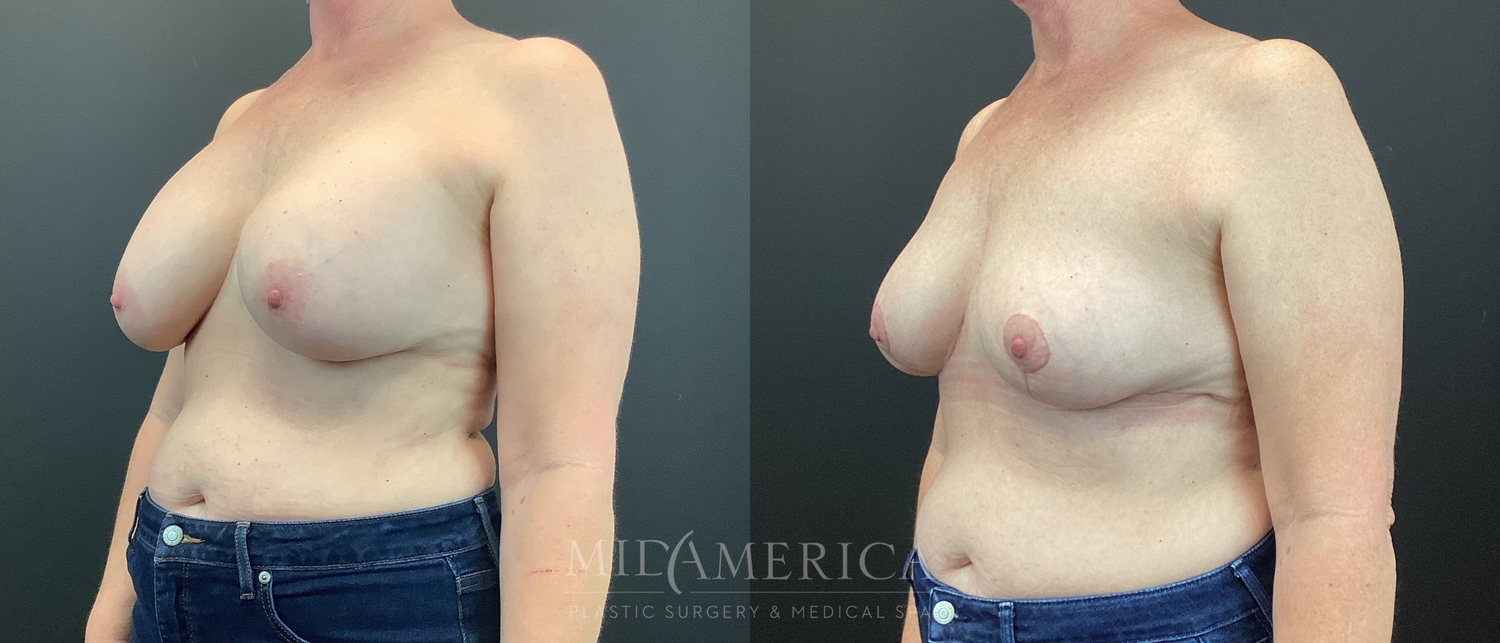 Implant Removal Before & After