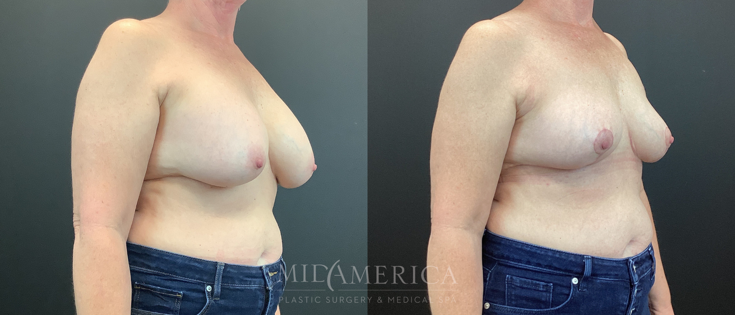 Implant Removal Before & After