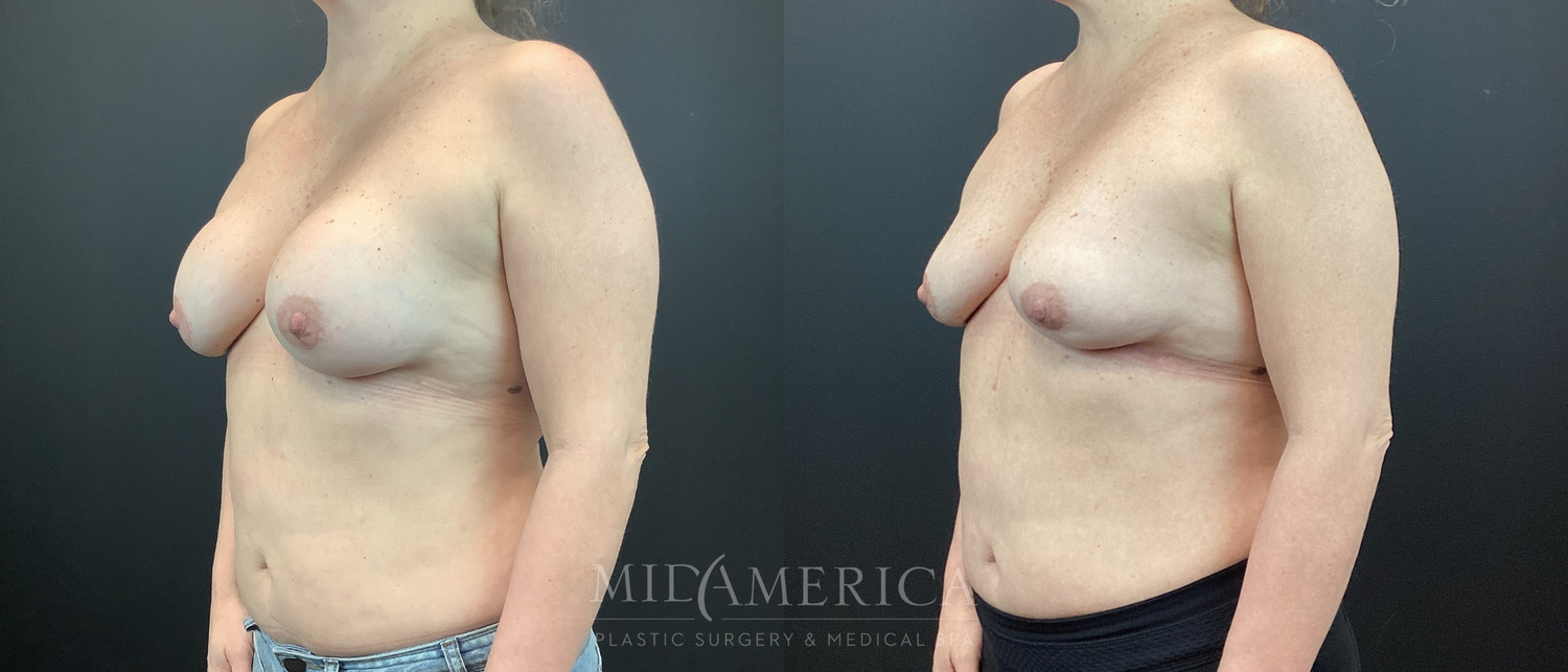 Implant Removal Before & After