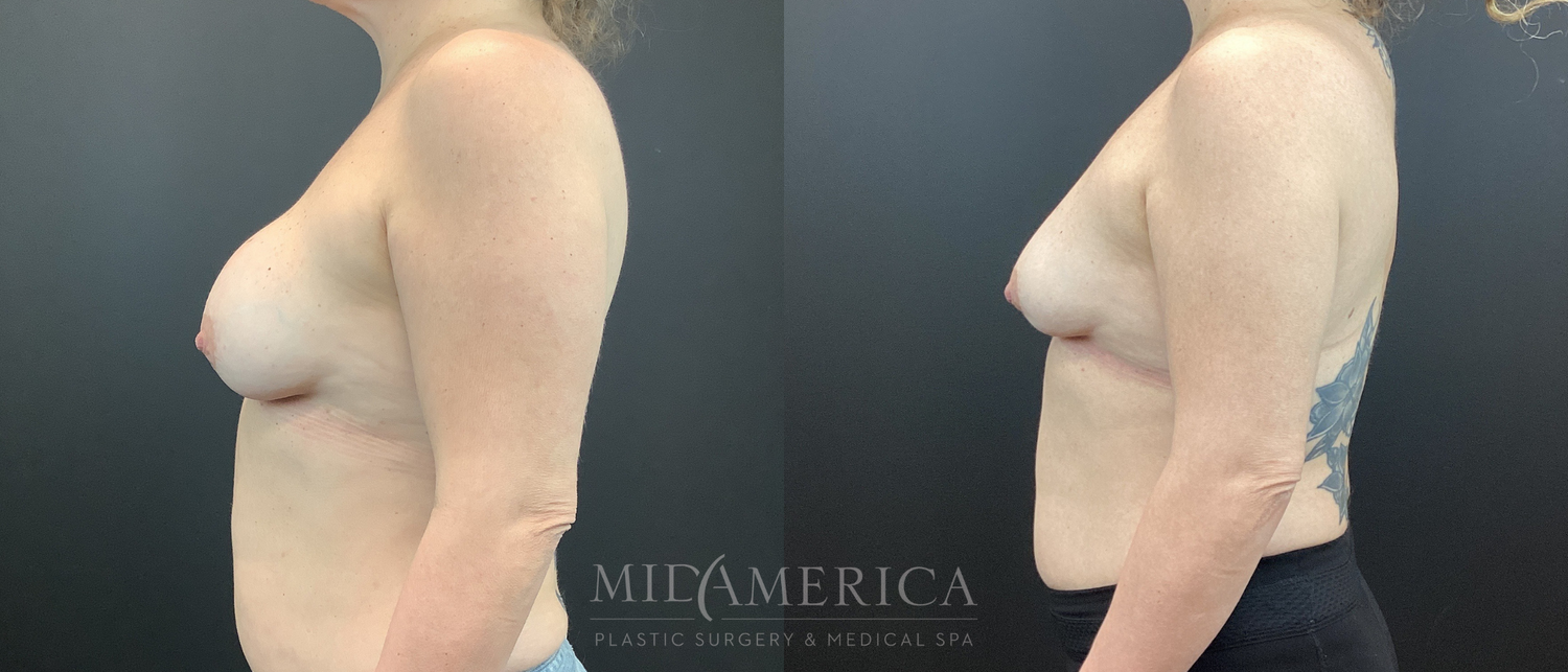 Implant Removal Before & After