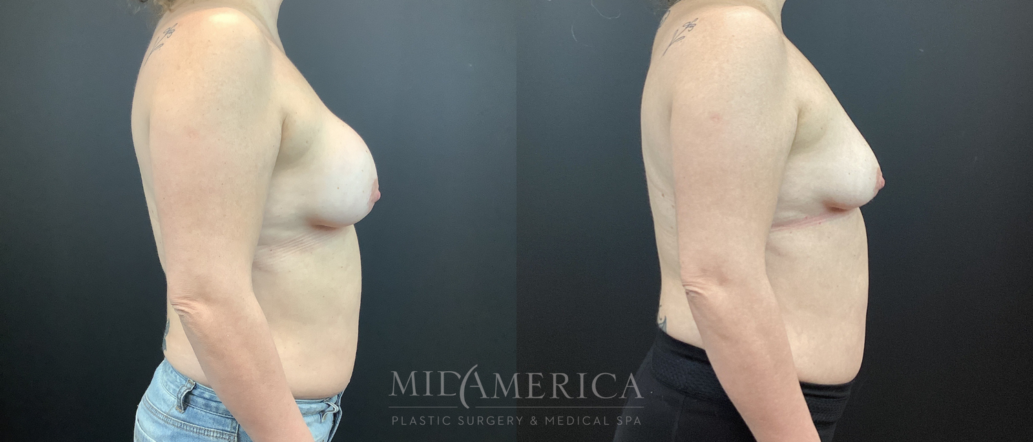 Implant Removal Before & After