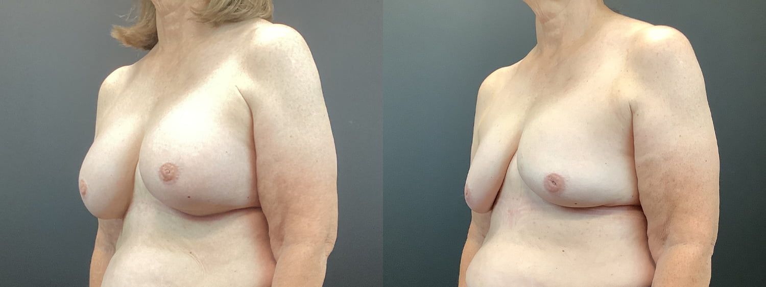 Implant Removal Before & After