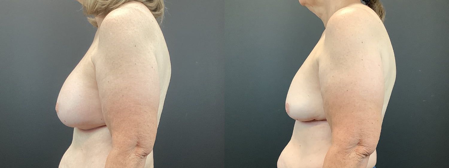 Implant Removal Before & After