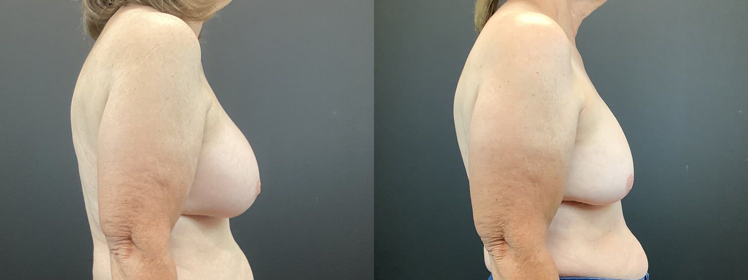Implant Removal Before & After
