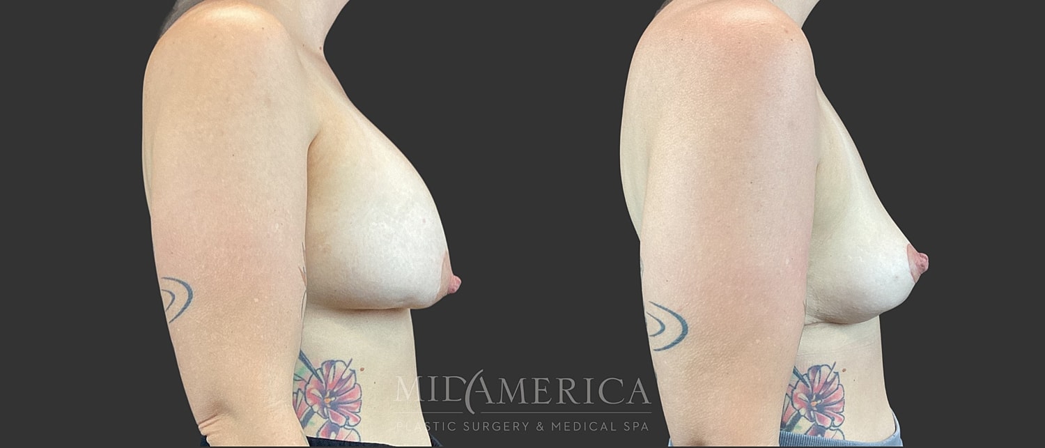 Implant Removal Before & After