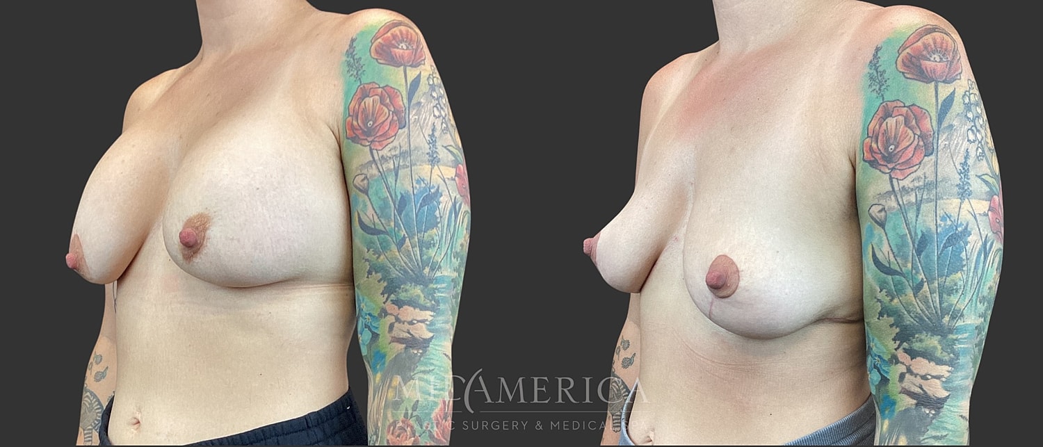 Implant Removal Before & After