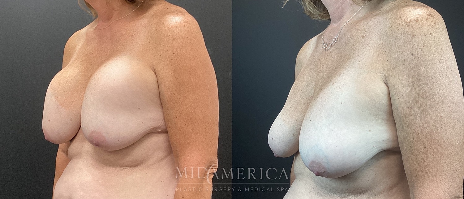 Implant Removal Before & After