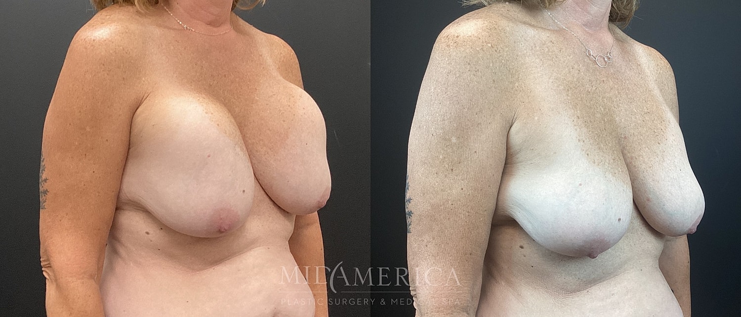 Implant Removal Before & After