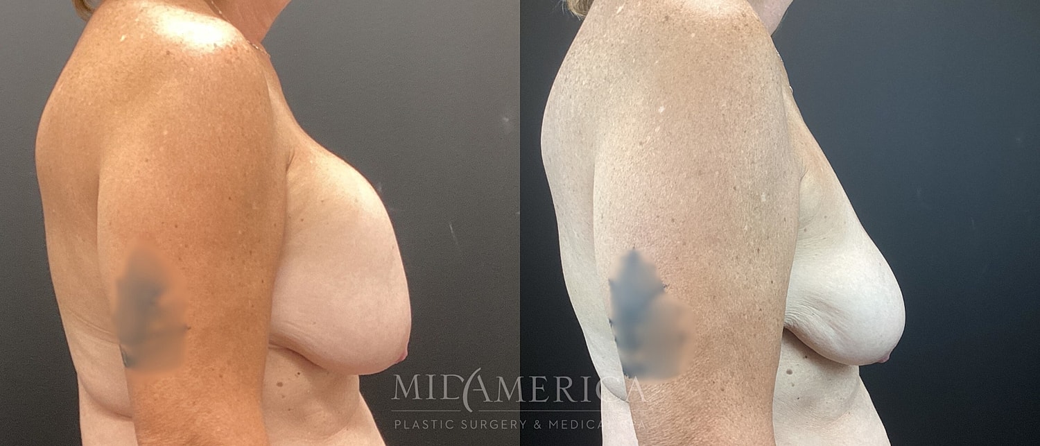 Implant Removal Before & After