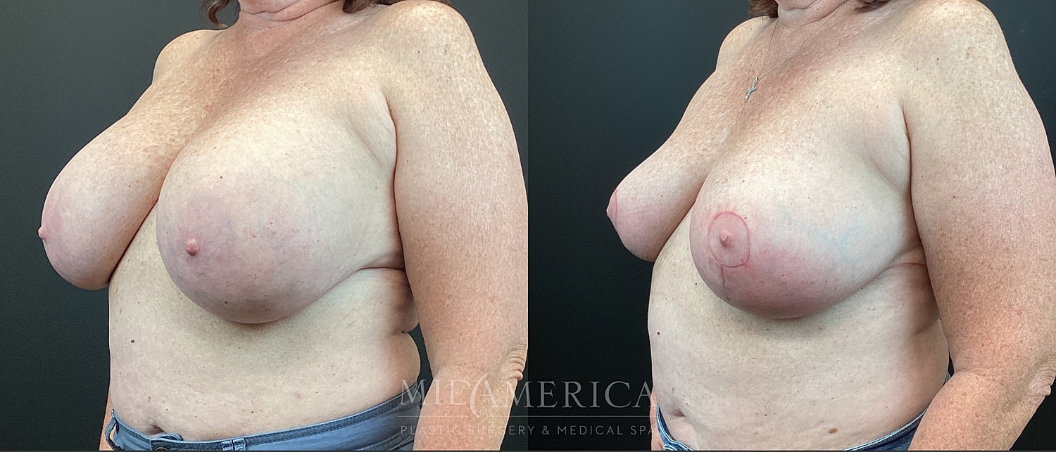 Implant Removal Before & After