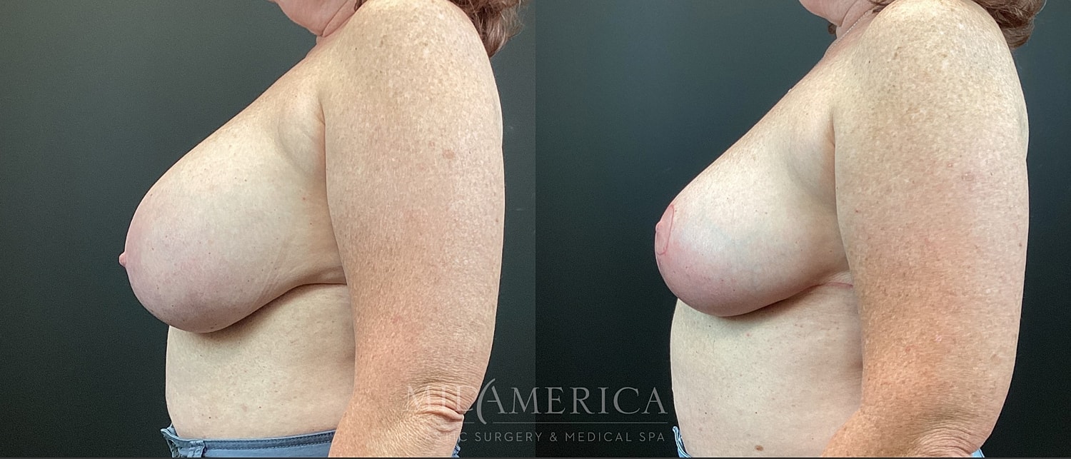 Implant Removal Before & After