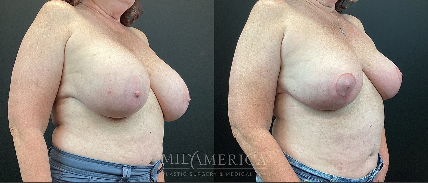 Implant Removal Before & After