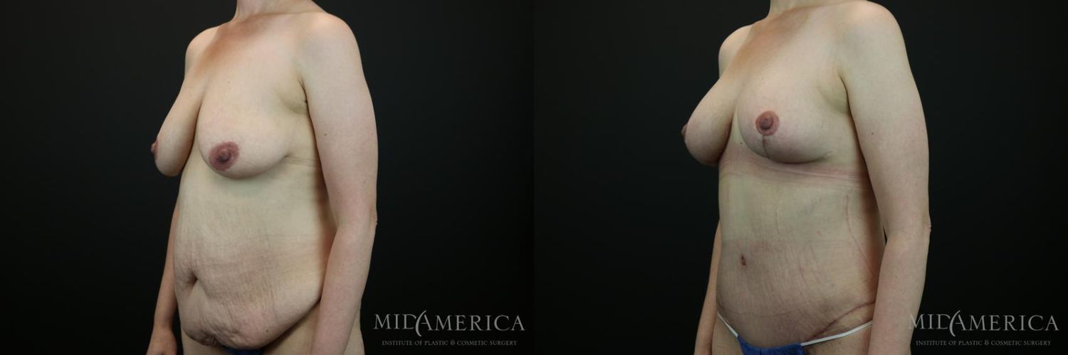 Mommy Makeover Before & After