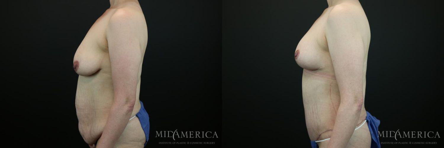 Mommy Makeover Before & After