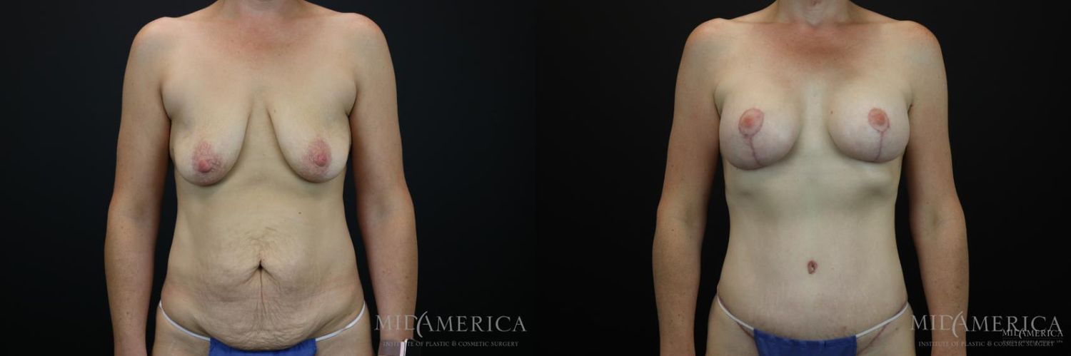 Mommy Makeover Before & After