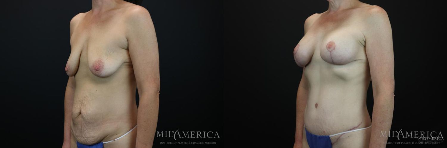 Mommy Makeover Before & After