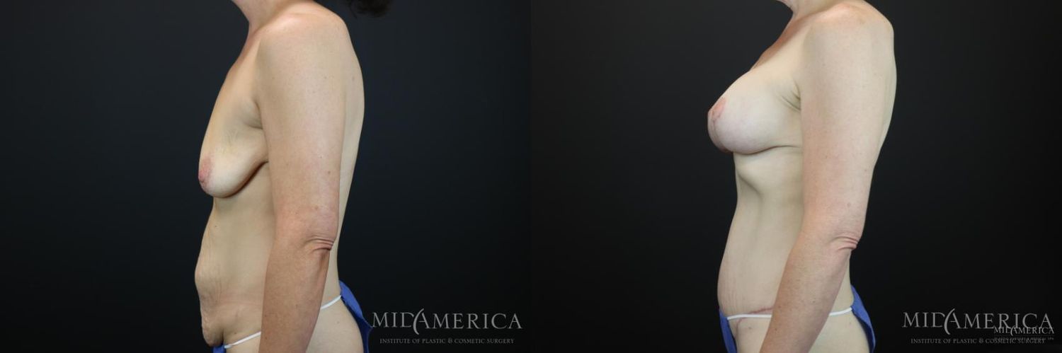 Mommy Makeover Before & After